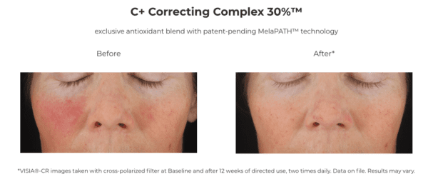 C+ Correcting Complex 30% before and after.