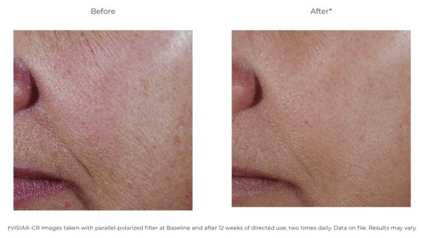 Before and after photos of a woman's skin using C+ Correcting Complex 30%.