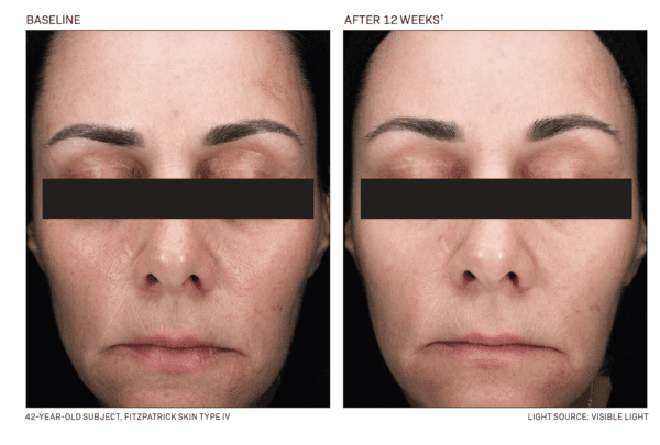 Before and after photos of a woman's DEJ Daily Boosting Serum.