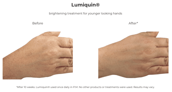 Lumiquin hand treatment before and after Lumiquin.
