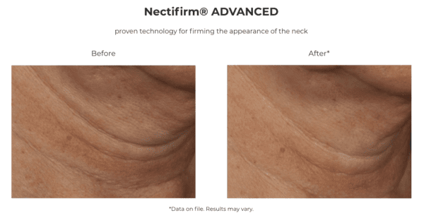 Nectifirm Advanced before and after.