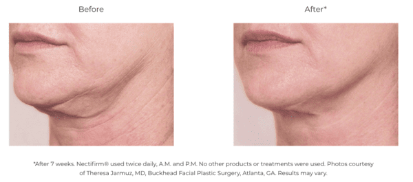A woman's face before and after Nectifirm.