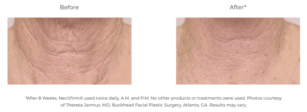 A woman's neck with wrinkles before and after using Nectifirm treatment.