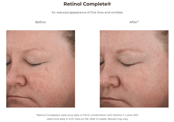 Retinol Complete 0.5 - before and after.
