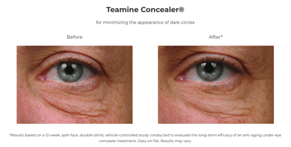 Teamine Eye Complex - before and after before and after Teamine Eye Complex.