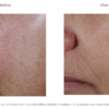 Before and after photos of a woman's skin using C+ Correcting Complex 30%.