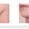 A woman's face before and after Nectifirm.